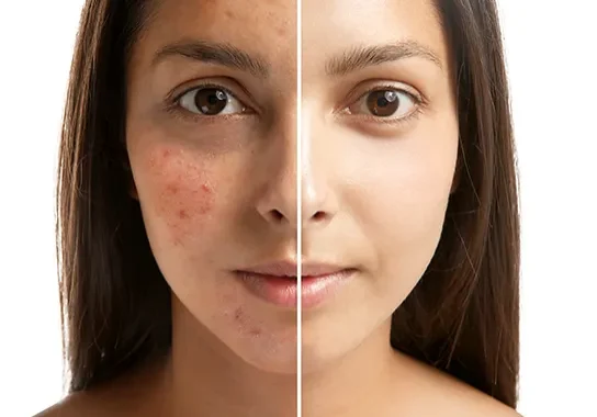 To ensure effective treatment, we personalize the process to suit your skin type and condition