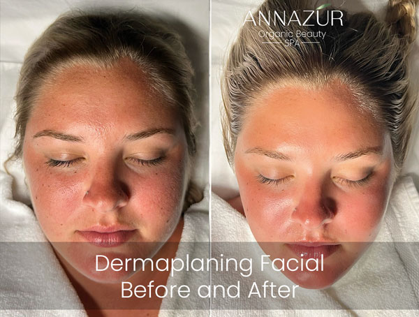 Before and after dermaplaning at ANNAZUR Organic Beauty Spa, Jacksonville FL — photo 2