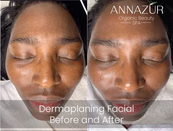 Before and after dermaplaning at ANNAZUR Organic Beauty Spa, Jacksonville FL — photo 3