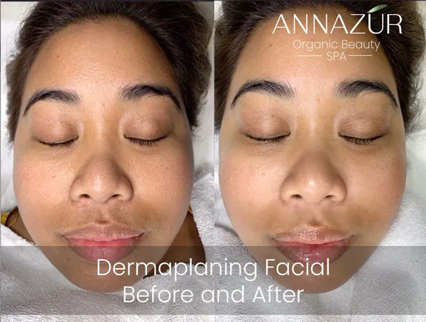Before and after dermaplaning at ANNAZUR Organic Beauty Spa, Jacksonville FL — photo 4