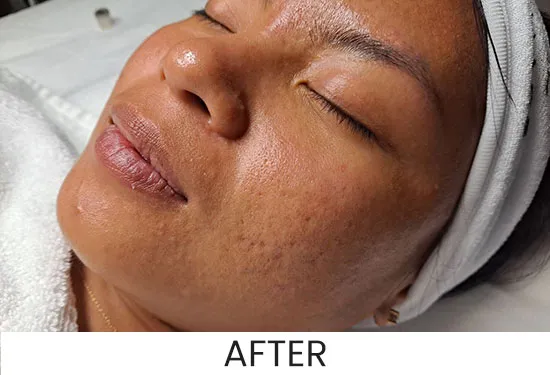 Before and after microdermabrasion in jacksonville at ANNAZUR Organic Beauty Spa, Jacksonville FL — photo 2