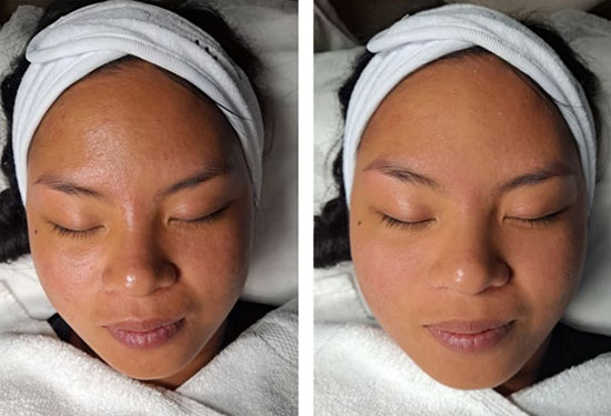 Before and after microdermabrasion in jacksonville at ANNAZUR Organic Beauty Spa, Jacksonville FL — photo 3