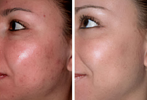 Before and after microdermabrasion in jacksonville at ANNAZUR Organic Beauty Spa, Jacksonville FL — photo 4