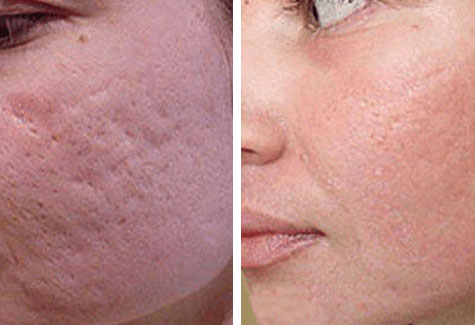 Before and after microdermabrasion in jacksonville at ANNAZUR Organic Beauty Spa, Jacksonville FL — photo 5