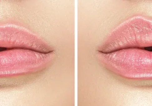 A before-and-after showing a maximum lip transformation, combining filler volume with the ideal shape and color from lip tattooing.