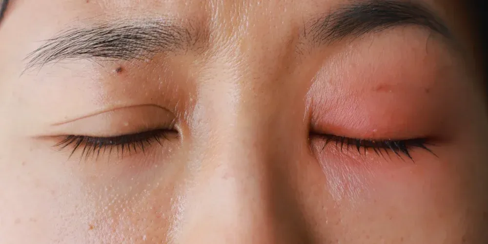 Irritation and Itchy Eyelash Extensions