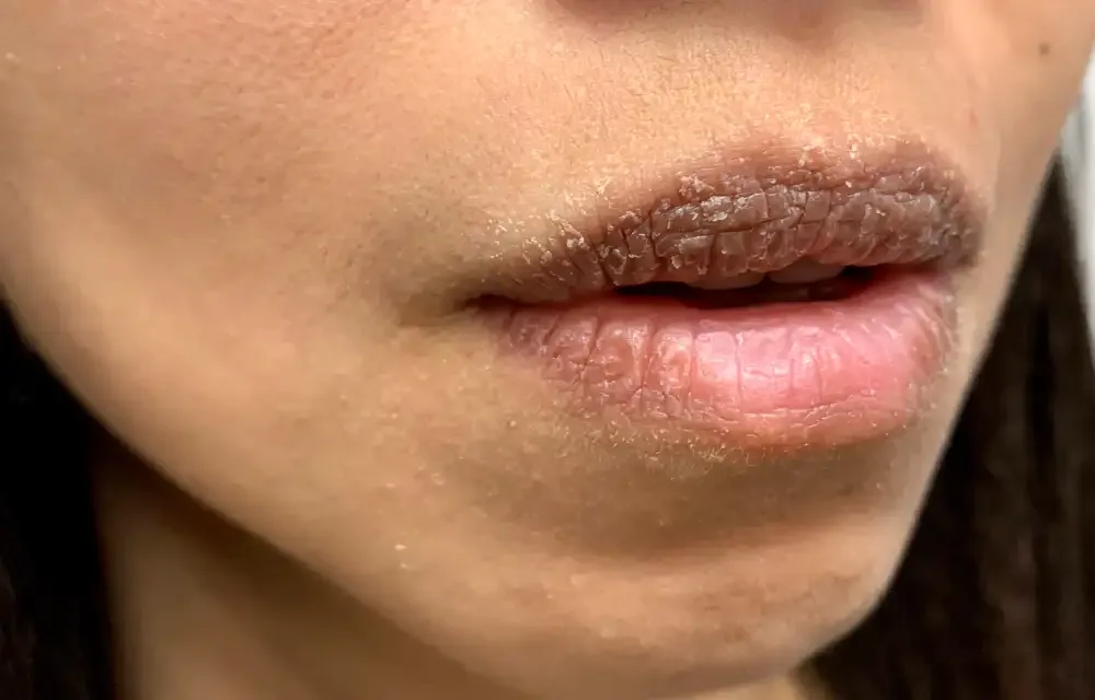 A close-up of a "lip blush gone wrong" result, showing uneven, patchy, and poorly healed color on the lips.