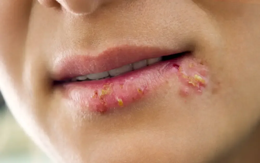 A close-up of severely infected or blistered lips, illustrating a serious complication like an infection or allergic reaction from lip blushing.