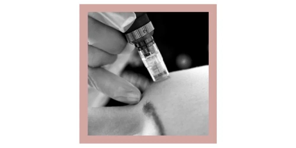 What Does Micro Needling Do For Your Skin