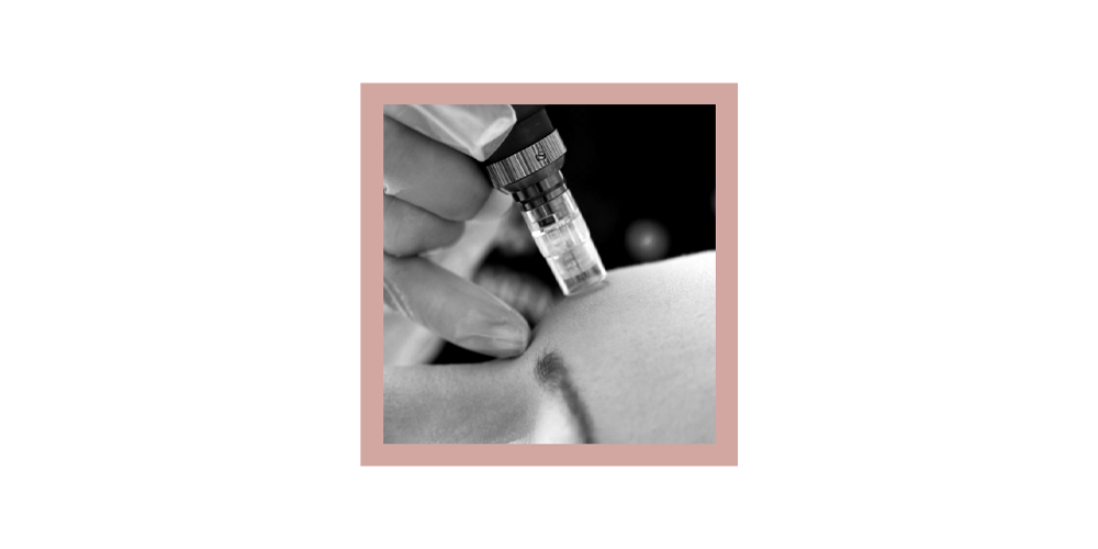 What Does Micro Needling Do For Your Skin