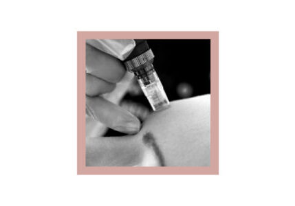 What Does Micro Needling Do For Your Skin