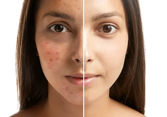 acne-treatment2
