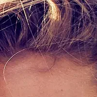 Scalp area displaying micropigmentation service results with natural density effect for hair loss