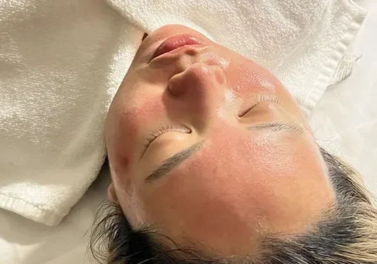 Microneedling Service Client