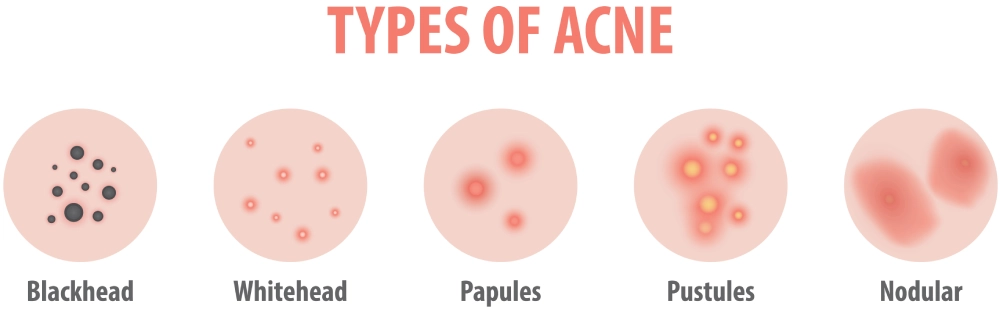 Different Types of Acne