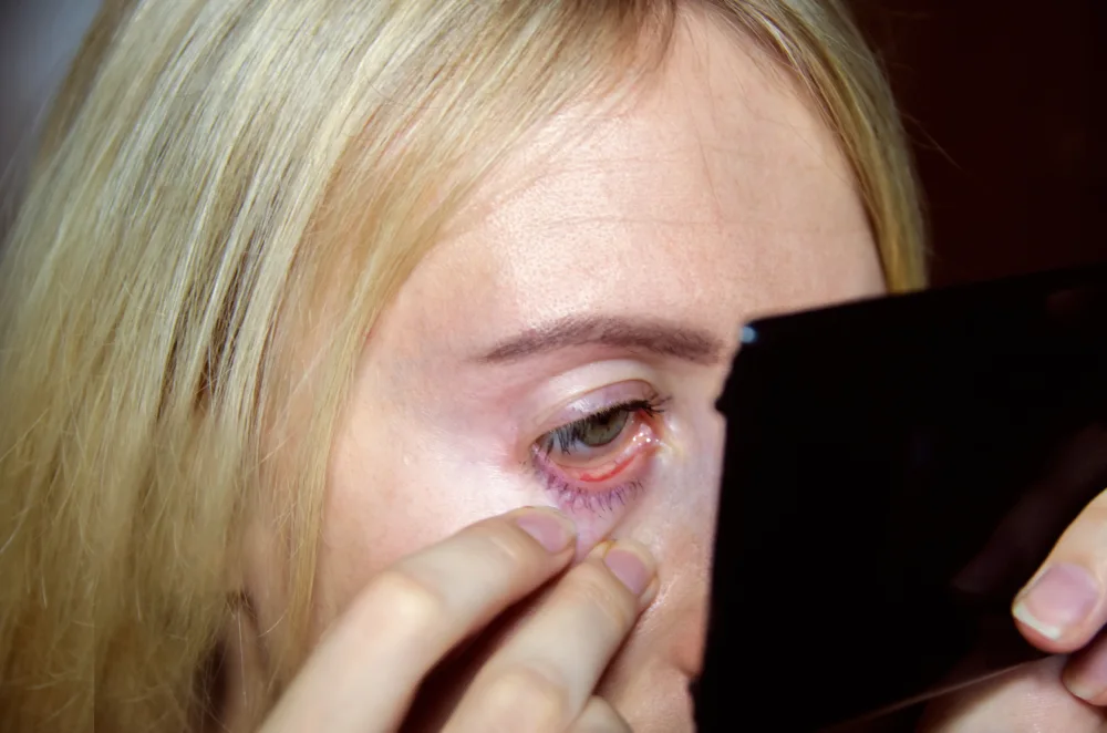 A woman inspects her irritated eyelid in a mirror, showing a client identifying symptoms of a lash allergy.