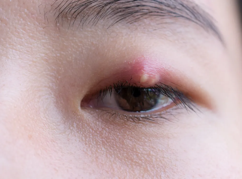 A close-up of a swollen eyelid with a stye, demonstrating a severe eye infection caused by poor hygiene.