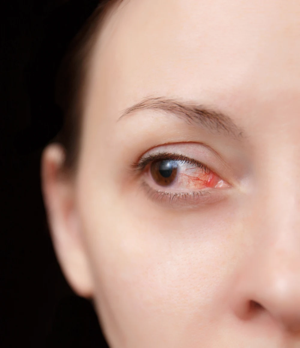 A close-up of a red, irritated eye, a symptom requiring immediate attention from a lash tech or doctor.