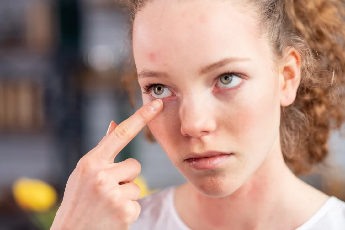 A woman points to her irritated under-eye skin, illustrating common side effects of lash serums like redness and itchiness.