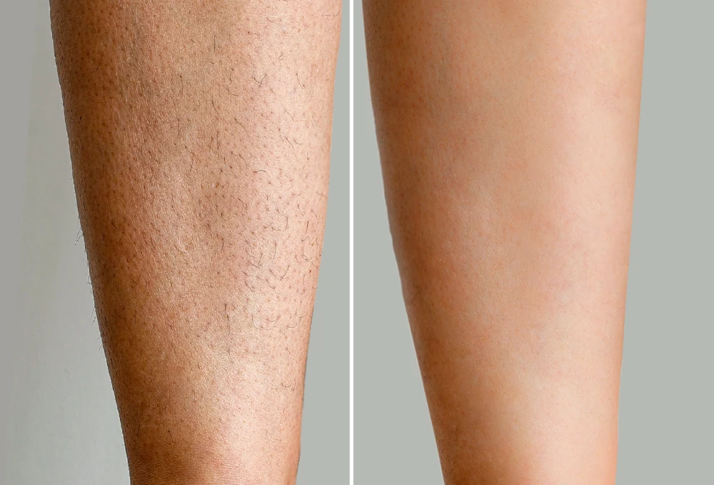 two legs, before and after waxing