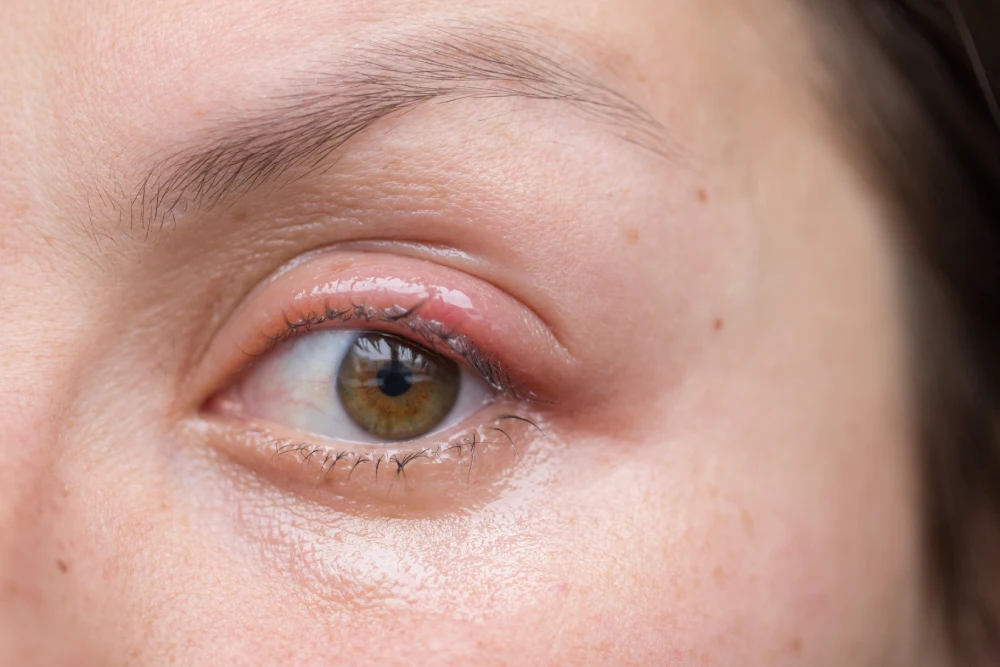 Less Common Allergic Reaction