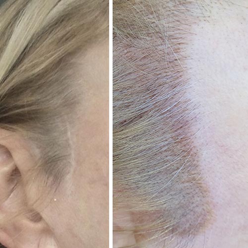 Scalp Micropigmentation Before & After