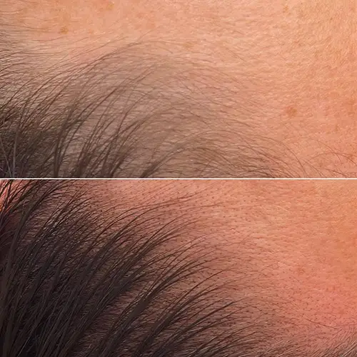 Scalp Micropigmentation Before & After