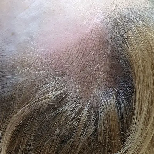 Scalp Micropigmentation Customer