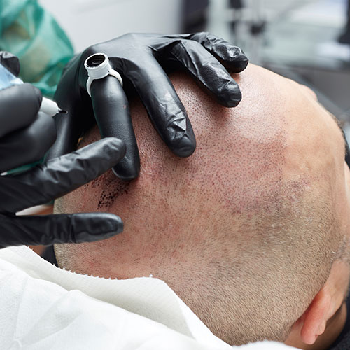 Man receiving scalp micropigmentation for baldness