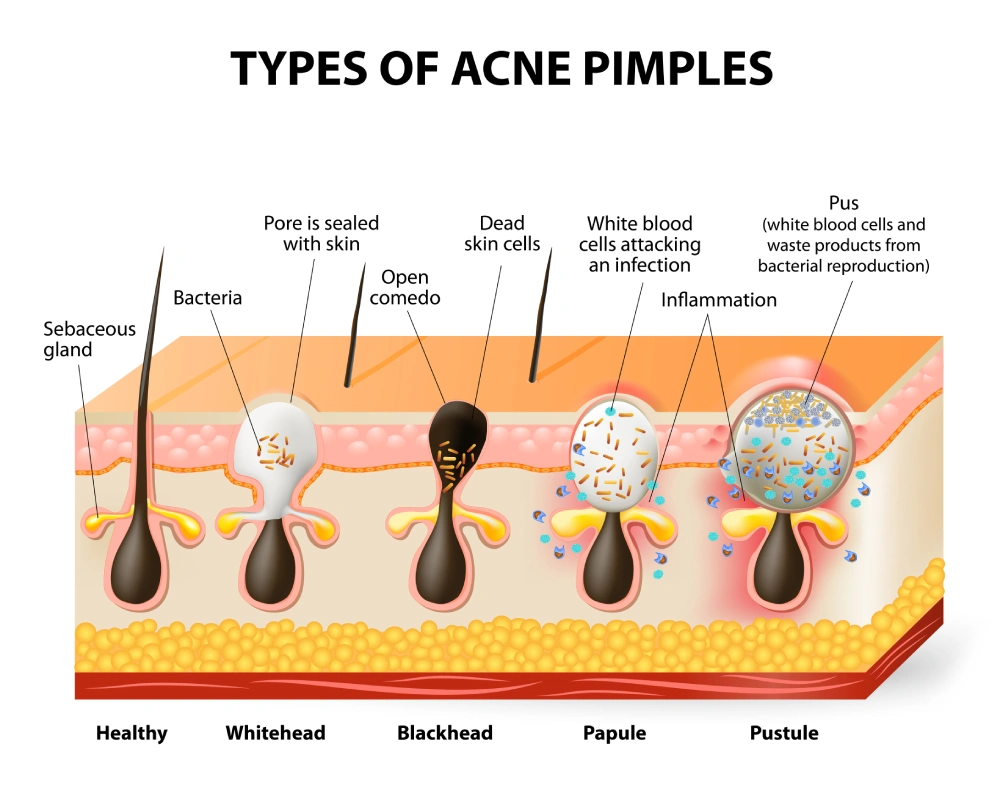 Skin Structure and the Formation of Acne