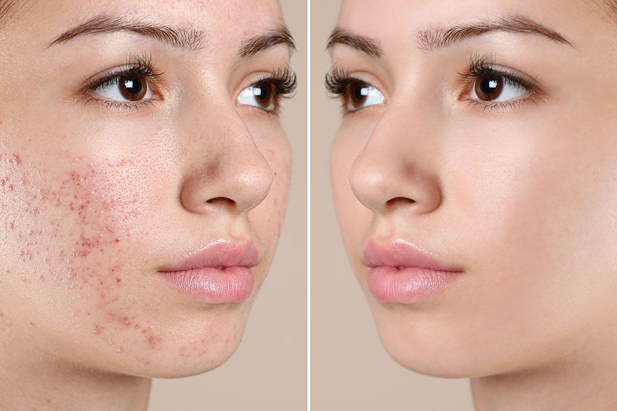 Acne Treatment Near Me in Jacksonville, FL ANNAZUR