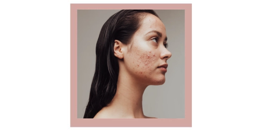 Girl with acne on her cheeks. Girl with acne on her cheeks.